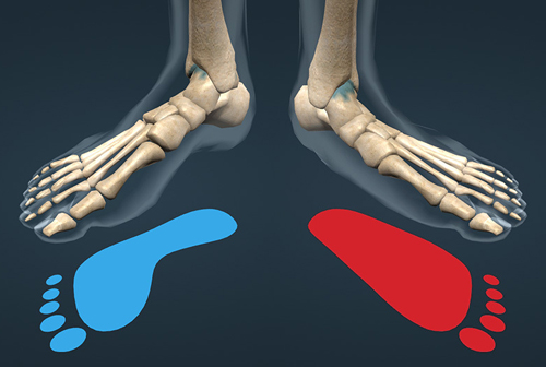 Làm thế nào để nhận biết sớm tình trạng bàn chân bẹt?